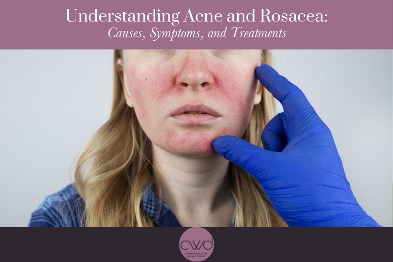 Understanding Acne and Rosacea: Causes, Symptoms, and Treatments