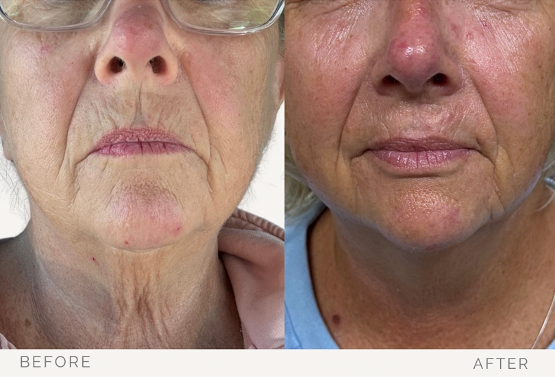 XERF Treatment