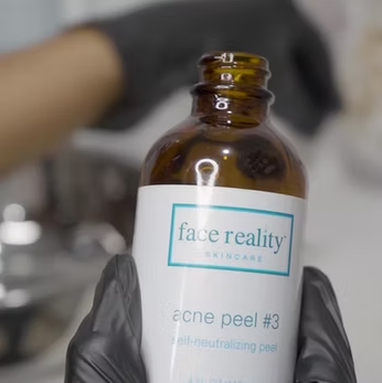 The Acne Bootcamp Peel
