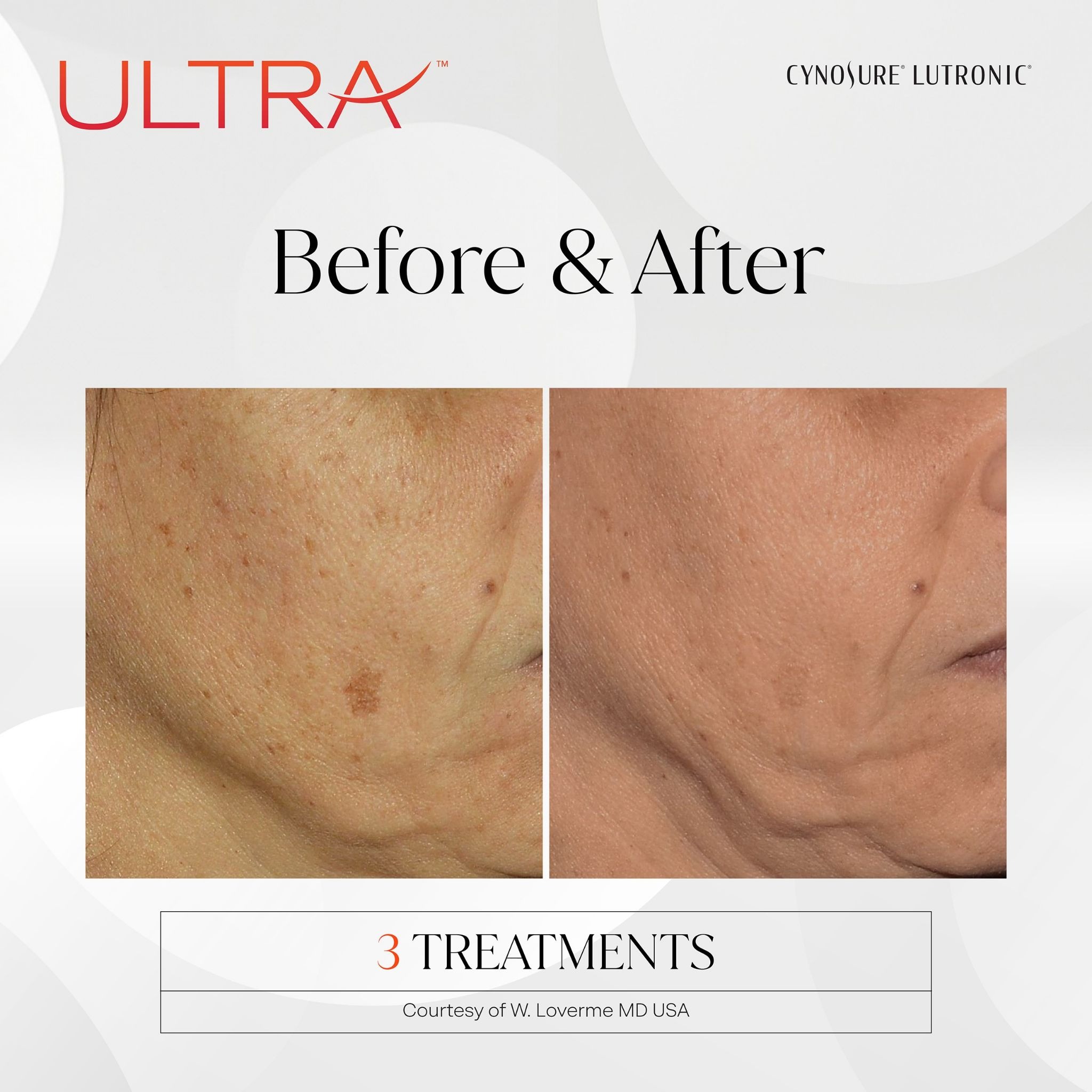 ULTRA Treatment