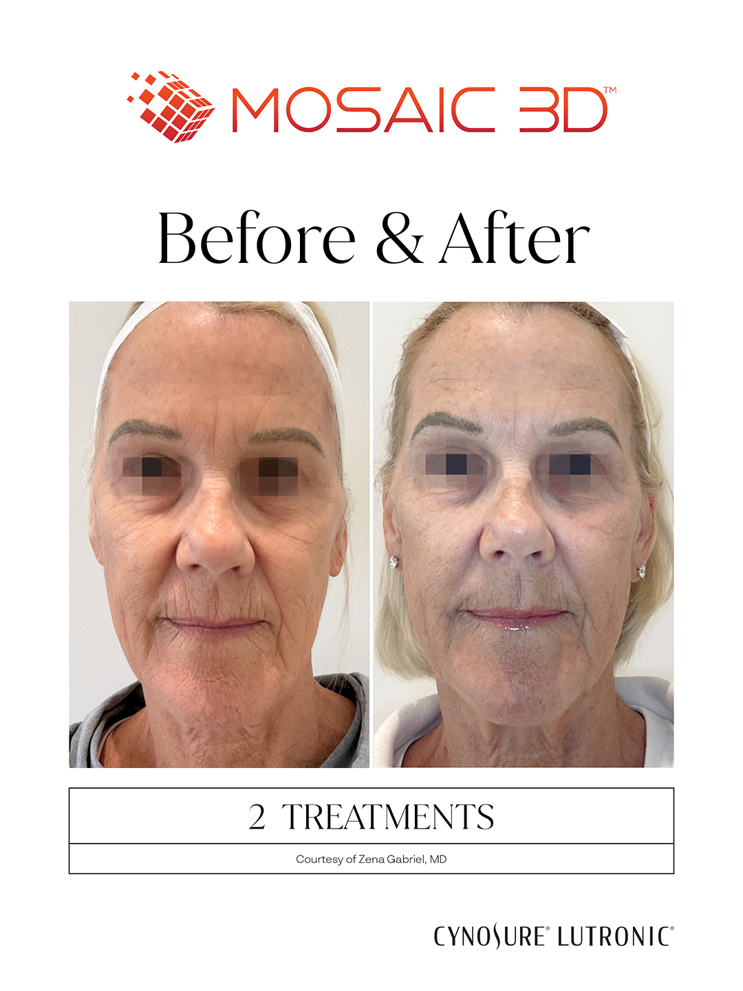 Mosaic 3D Treatment