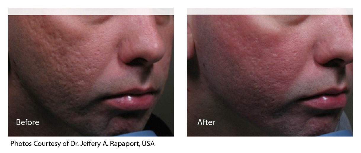 eCO2 Laser Resurfacing